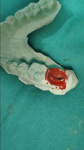 Endocrown / PFM CROWN / Porcelain fused to metal crown / FULL coverage restoration