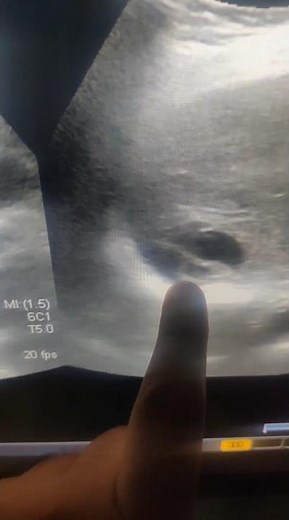 Liver Hydatid Cyst on Ultrasound | Classic Radiology Finding