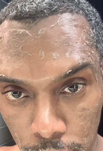 Replying to @️ℛℴ𝓈ℯ 6-7 days of Progressive Shedding 👍🏽, Not Trauma 🙅🏾‍♂️. (Fast forward to the 1:48 mark too see my whole face shedding 😵‍💫😅) This is my full peel cycle 🔁 . Hours after application. Day 1. Day 2. Day 3. By Day 4, the work is visible. Days 6 to 7, complete renewal. No burns. No issues. No shortcuts. Just intentional application, proper aftercare, and skin responding beautifully to the process. ✨ #losangelesesthetician #chemicalpeel #losangeles #atlantaesthetician #blackes
