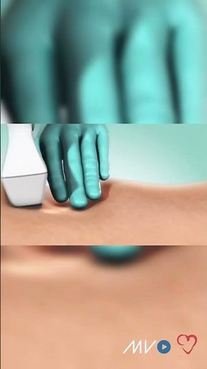 Vein Disease Treatment using Adhesive
