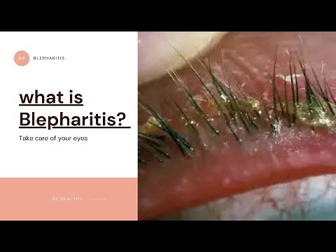 What is Blepharitis? Dandruff in eyelid |causes |symptoms |Treatment