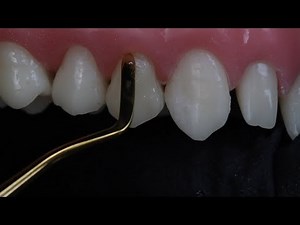 Class V Composite Restoration • Video • MEDtube.net