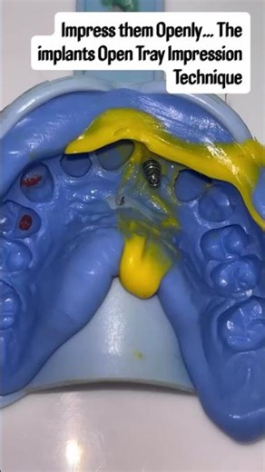Impress them openly 💃The implants Open Tray Impression Technique #dentist #dentalprosthesis #smile