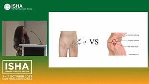 A Review of the Treatment Options of Greater Trochanteric Pain Syndrome (GTPS): Open vs Arthroscopic