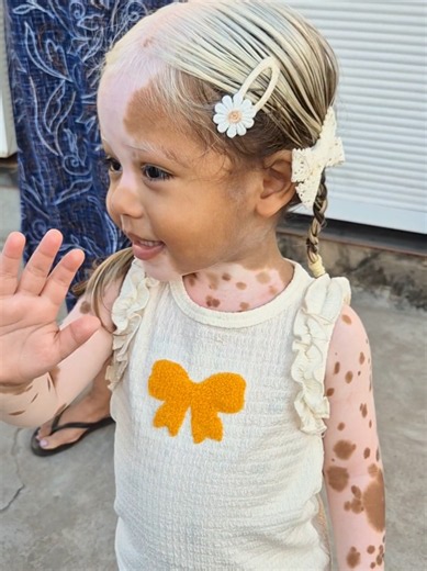 Bebês engraçados e felizes com piebaldismo
