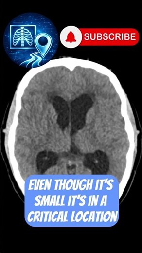 This Tiny Brain Lesion Can Be Deadly #Radiology #neuroradiology