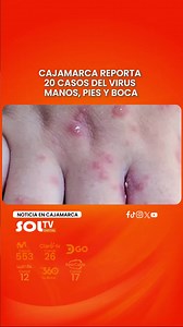 Brotes de manos, pies y boca en Cajamarca: 20 casos confirmados