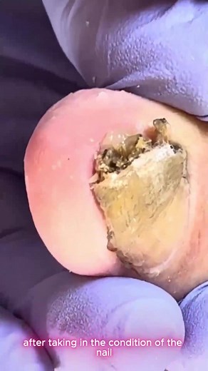 196K views · 940 reactions | Best Practices to Help People with Thick Toenails Protect Aging Feet #SafeNailCare #FootHealthUSA #NonCuttingMethod #ThickToenailCare | Evgeniy | Facebook