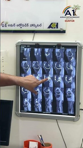 Mokalu noppi - Rare cause | ACL ganglion cyst
