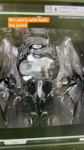 MRI PLEVIS WITH BOTH HIP JOINT #contentcreat #medical #viralvideo #lifeisbutadream #youtubevloggers