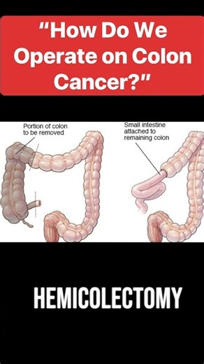 Colon Cancer Surgery: Types and Procedures Explained