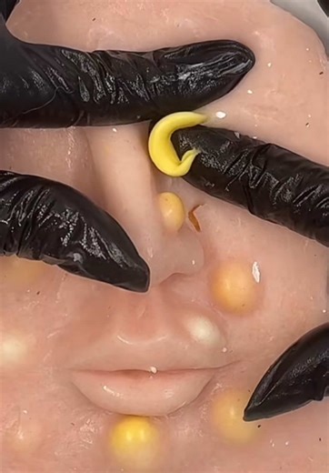 Effective Face Pimples Removal Techniques for Clear Skin