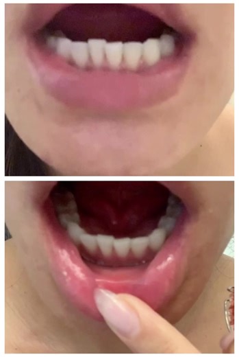 Retainer Before and After: Overnight Transformation
