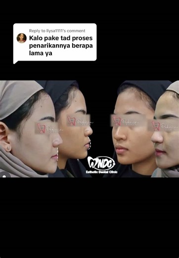 Replying to @llysa1111 Rata2 proses penarikan gigi dengan menggunakan tad /mini screw 6-12 bulan ❤️❤️ Nortist Nina Orthodontist #doknin #ortodontistmalang #drgninaagustin #behelgigimalang #klinikgigimalang #ndc#ndcdentalmalang