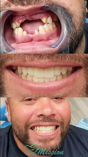 Dental Bridges At The Smile Mission