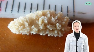 What exactly are kidney stones and how do you get one? | Everything Explained