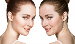 How to get rid of acne? 19 tips to get back your acne-free glowing and healthy skin