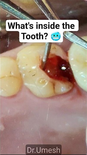 Surprise inside your Tooth🦷 Pulp Stone 🪨 #shorts #youtubeshorts #shortvideo