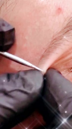 #pimplepop #oddlysatisfying #acnepopper #pimple #acneremoval #pimplepopper2021 perfect job