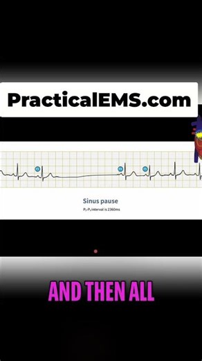 SA Node FAILS to Fire! What is a Sinus Pause? #shorts