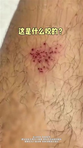 被这些虫子咬了怎么办，20s教你分清处理 #蚊虫叮咬 #虫咬皮炎 #蟑螂 #抖出健康知识宝藏 #防虫