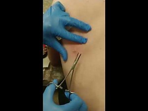 Home cyst removal (mute sound - lots of dramatic gagging)