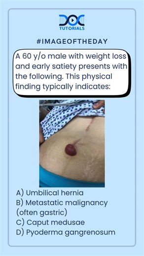 DocTutorials - NEET PG on Instagram: "#imageoftheday 👉 A 60 y/o male with weight loss and early satiety presents with the following. This physical finding typically indicates: A) Umbilical hernia B) Metastatic malignancy (often gastric) C) Caput medusae D) Pyoderma gangrenosum 💬 Drop your answer in the comments 👇 #NEETPG #ImageOfTheDay #ClinicalSpotter #NEETPGPreparation #FMGE #INICET #MedicalMCQs #ImageBasedQuestions #ExamRecall #MetastaticMalignancy #GastricCancer #MedicalEducation #DocTuto