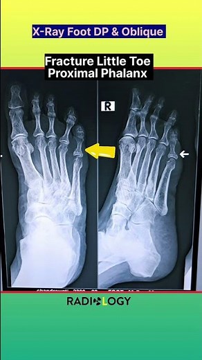 Fracture Little Toe Proximal Phalanx ⚡ X-Ray Foot #shorts #xray #fracture