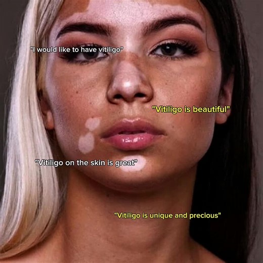 Understanding Vitiligo Through Mike's Story