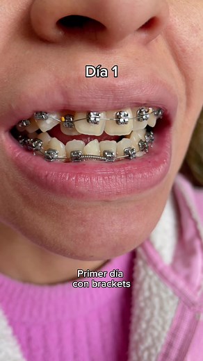 Avance de Ortodoncia: Meses con Brackets