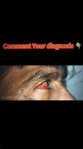 Sudden Blood In The Eye With No Pain? Comment Your Diagnosis! 😨#visiontips #fyp