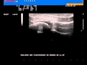 Echographie fléchisseurs des doigts