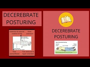 DECEREBRATE POSTURE(Abnormal Posturing)