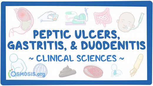 Peptic ulcers, gastritis, and duodenitis (pediatrics): Video & Meaning | Osmosis