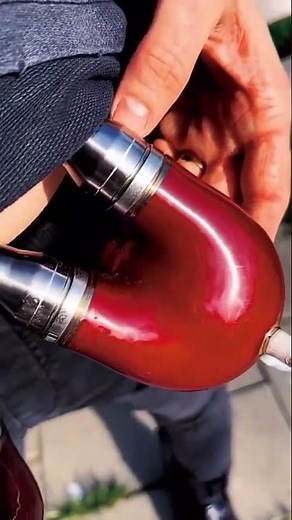 Patient lives on an artificial heart also known as “ventricular assist device” VAD