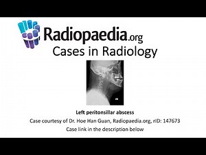 Left peritonsillar abscess (Radiopaedia.org) Cases in Radiology