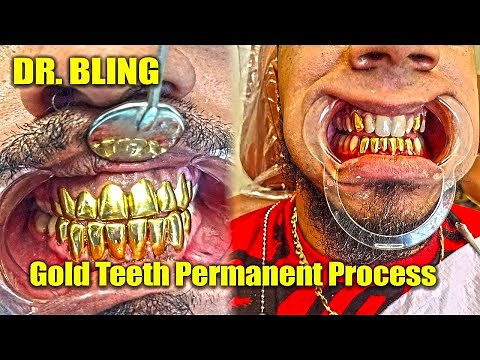 Gold Teeth Permanent Process | DR. Bling