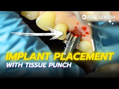 Implant Placement with Tissue Punch