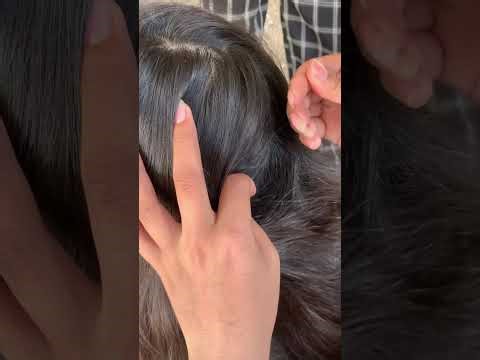 (Part 29) Lice Removal & Treatment Satisfying | Lice Popping