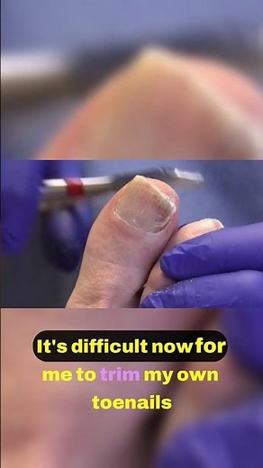 Patient Explains Why She Can't Trim Her Own Nails #MyastheniaGravis #MedicalShorts #ChronicLife