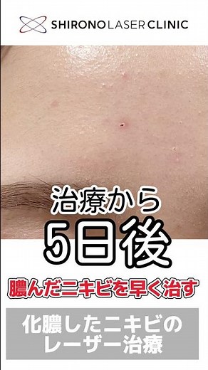 ニキビが膿んで痛い…炎症ニキビのレーザー治療 #shorts #にきび