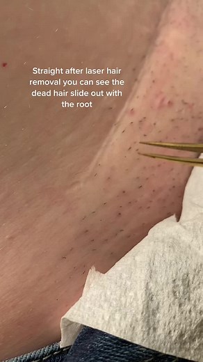 Watch the dead hair and root slide out after laser hair removal. #laser #laserclinic #alexandritelaser #hairfree #laserhairremoval #burn