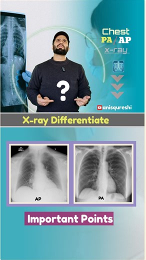 Anis Qureshi 🍁 on Instagram: "PA vs AP Chest X-ray | True Cardiac Size is Seen in PA 🫀🩻 In this reel, I have explained the simple and practical way to differentiate PA and AP chest X-ray. ✔️ Heart Size – True cardiac size is seen in PA view because the heart is closer to the detector. In AP view, the heart appears enlarged due to magnification (false cardiomegaly). ✔️ Scapula – In PA view, scapula are outside the lung fields. In AP view, scapula overlap the lung fields. ✔️ Clavicle – In PA vi