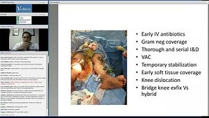 Open Tibia Fracture Case
