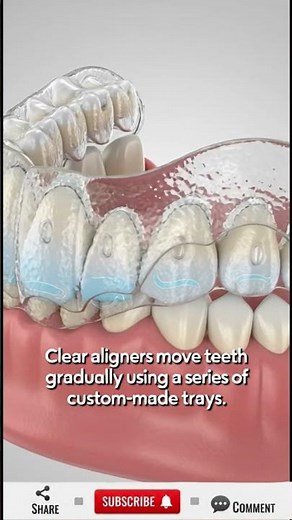 Braces vs Clear Aligners: What’s Happening Inside Your Mouth?