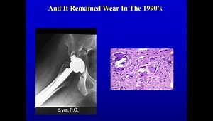 Total Hip Replacement: Problems Solved?