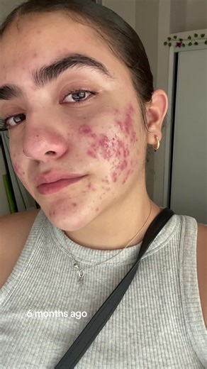 Inflamed Acne Journey: October Skin Inflammation Experience