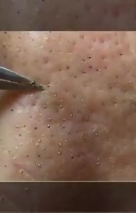 Pimple Popping 2021 on Instagram‎: "Follow : @daily.pimple.popping and get awesome skin routine tutorial 😍⁣⁣⁣ .⁣⁣⁣⁣ .⁣ . . #acne #antiaging #acnetreatment #blackheadremoval #blackhead #blackheads #blackheadextraction #facialathome #cyst #clearskin #dermaplaning #drpimplepopper #dermaplane #drsandralee #glowingskin #oilyskin #pimple #pimplepopper #pimpleproblems #pimplepopping #pimplepoppers #skincare #naturalskin #sivilcesıkma #zits #skinhealth #skincaretips #черныеточки #выдавливаниепрыщей #جو