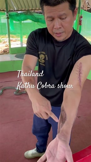 56. Kathu Cobra Show in Phuket. Man shows off snake bite and what the poison did to his arm.