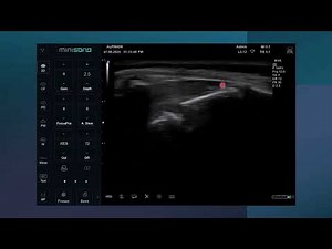 Ultrasound guided caudal epidural block